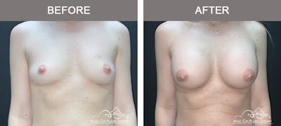 Breast Augmentation Before & After Gallery - Patient 106185 - Image 1