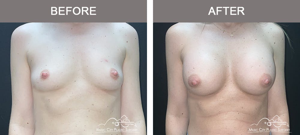 Breast Augmentation Before & After Gallery - Patient 106185 - Image 1