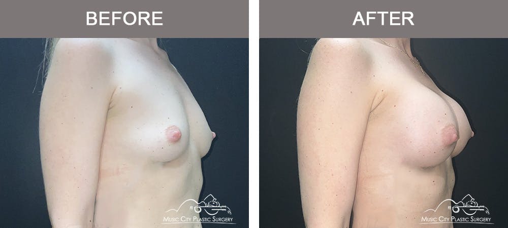 Breast Augmentation Before & After Gallery - Patient 106185 - Image 2