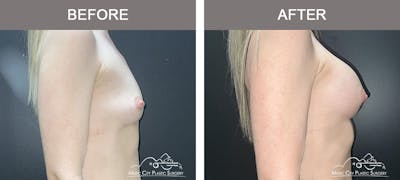 Breast Augmentation Before & After Gallery - Patient 106185 - Image 3