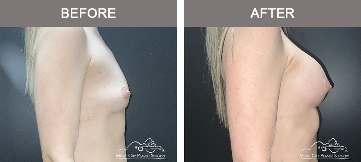 Breast Augmentation Before & After Gallery - Patient 106185 - Image 3