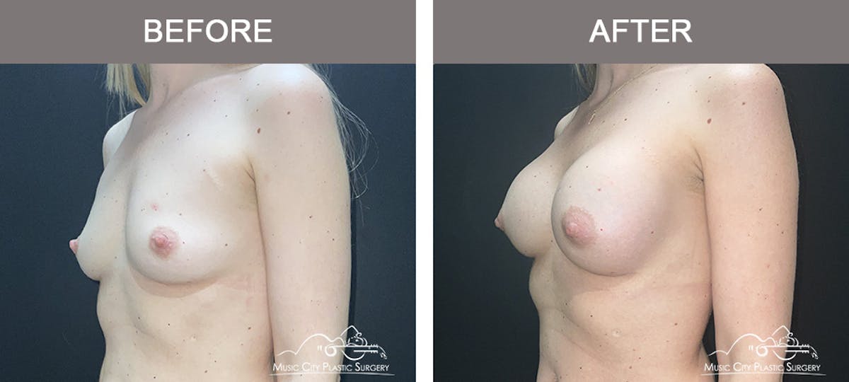 Breast Augmentation Before & After Gallery - Patient 106185 - Image 4
