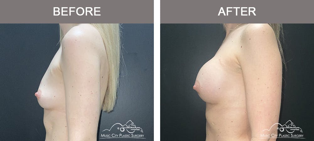 Breast Augmentation Before & After Gallery - Patient 106185 - Image 5