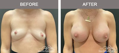 Breast Augmentation Before & After Gallery - Patient 390467 - Image 1