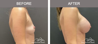 Breast Augmentation Before & After Gallery - Patient 390467 - Image 2