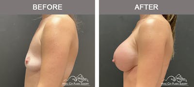 Breast Augmentation Before & After Gallery - Patient 390467 - Image 3