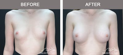 Breast Augmentation Before & After Gallery - Patient 196443 - Image 1