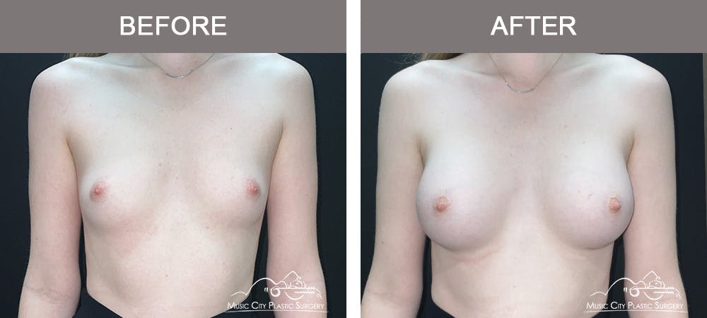 Breast Augmentation Before & After Gallery - Patient 196443 - Image 1