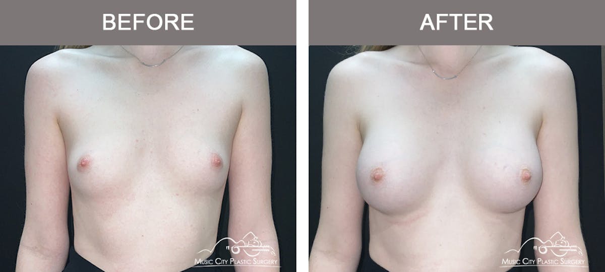 Breast Augmentation Before & After Gallery - Patient 196443 - Image 1