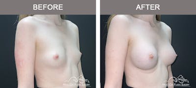 Breast Augmentation Before & After Gallery - Patient 196443 - Image 2