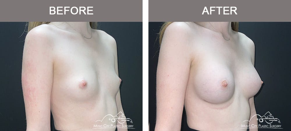 Breast Augmentation Before & After Gallery - Patient 196443 - Image 2