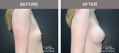 Breast Augmentation Before & After Gallery - Patient 196443 - Image 3