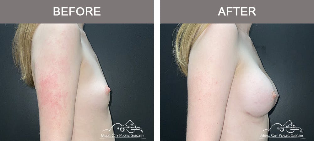 Breast Augmentation Before & After Gallery - Patient 196443 - Image 3