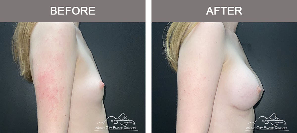 Breast Augmentation Before & After Gallery - Patient 196443 - Image 3