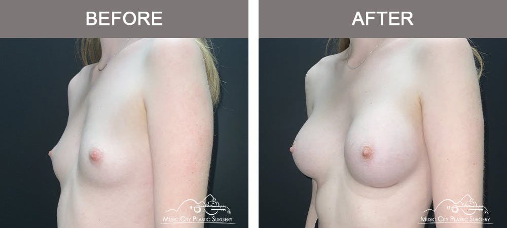 Breast Augmentation Before & After Gallery - Patient 196443 - Image 4