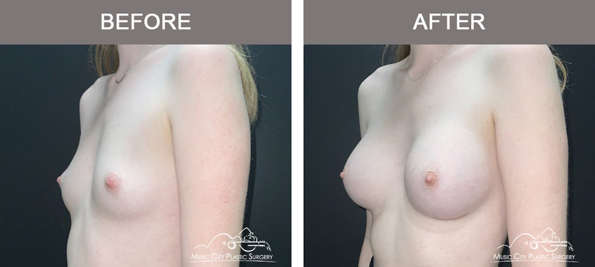 Breast Augmentation Before & After Gallery - Patient 196443 - Image 4