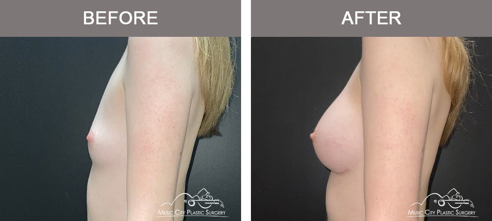 Breast Augmentation Before & After Gallery - Patient 196443 - Image 5