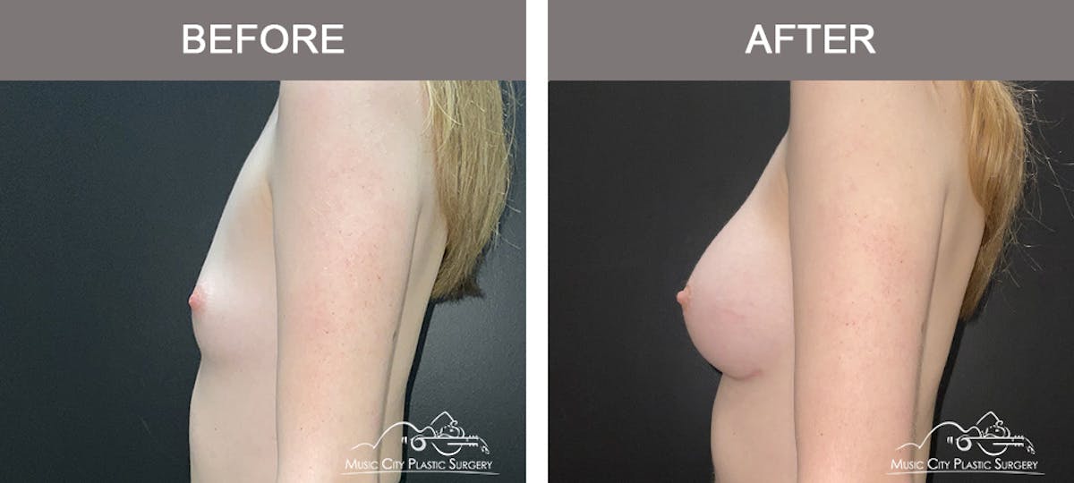 Breast Augmentation Before & After Gallery - Patient 196443 - Image 5