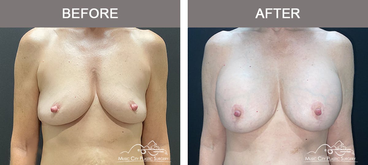 Breast Augmentation Before & After Gallery - Patient 270049 - Image 1
