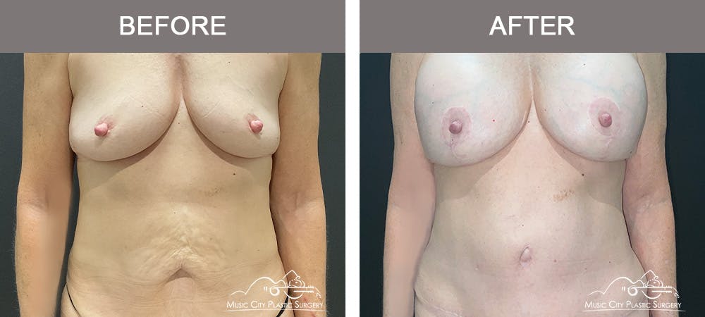 Breast Augmentation Before & After Gallery - Patient 270049 - Image 2
