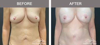 Liposuction Before & After Gallery - Patient 282503 - Image 1