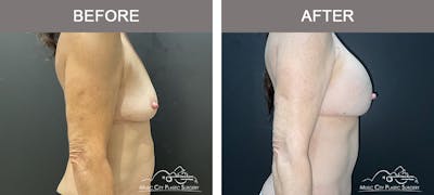 Breast Augmentation Before & After Gallery - Patient 270049 - Image 3
