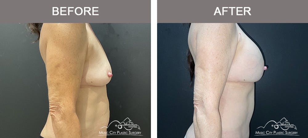 Breast Augmentation Before & After Gallery - Patient 270049 - Image 3