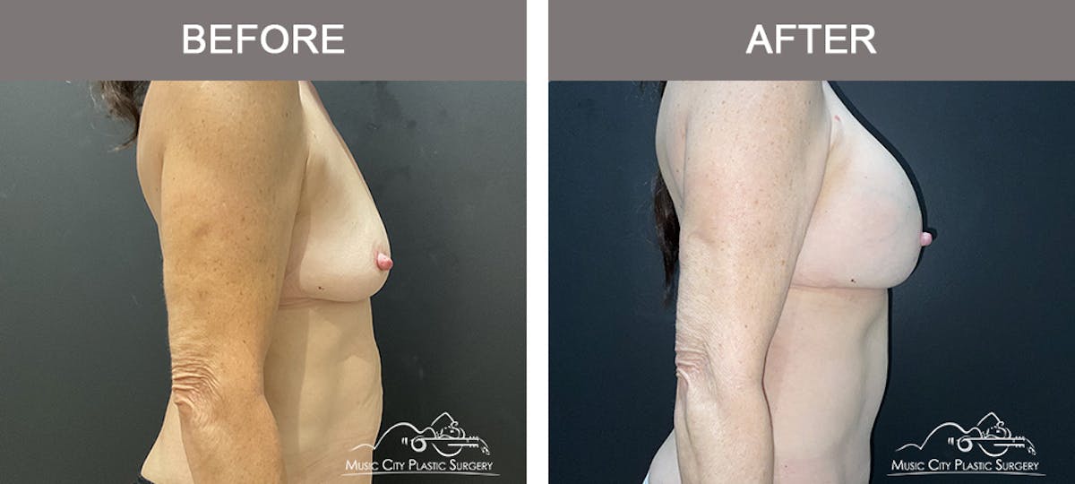 Breast Augmentation Before & After Gallery - Patient 270049 - Image 3