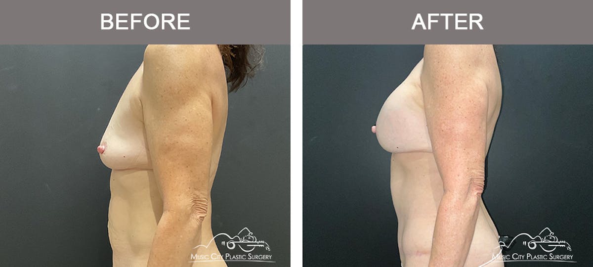 Breast Augmentation Before & After Gallery - Patient 270049 - Image 4