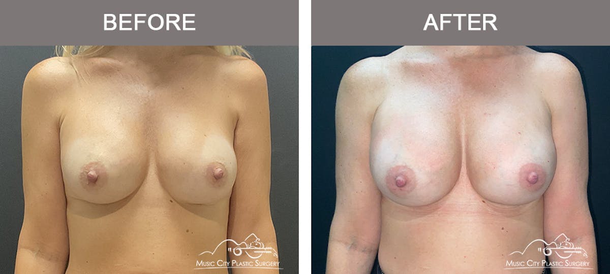 Implant Exchange Before & After Gallery - Patient 165442 - Image 1