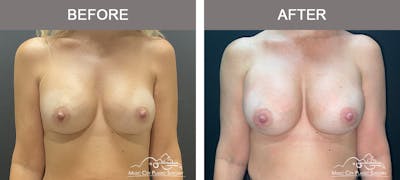 Implant Exchange Before & After Gallery - Patient 165442 - Image 1