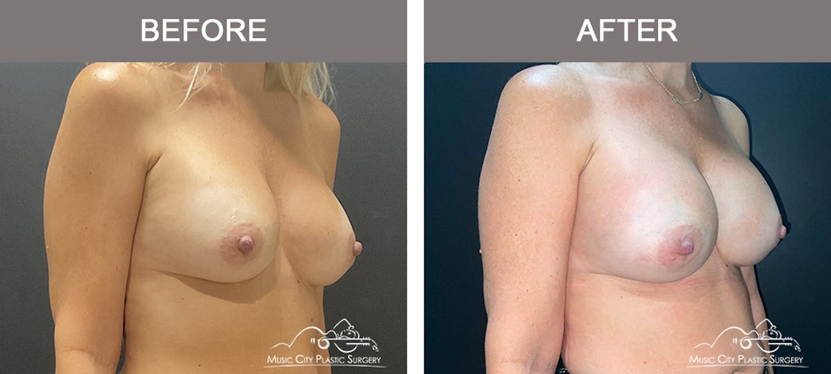 Implant Exchange Before & After Gallery - Patient 165442 - Image 2