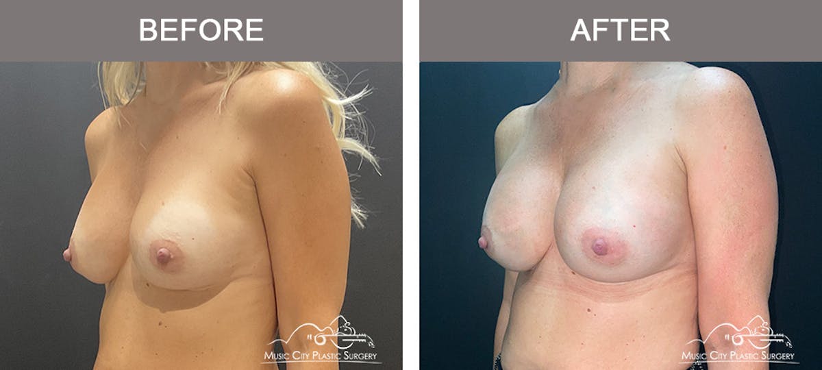 Implant Exchange Before & After Gallery - Patient 165442 - Image 3