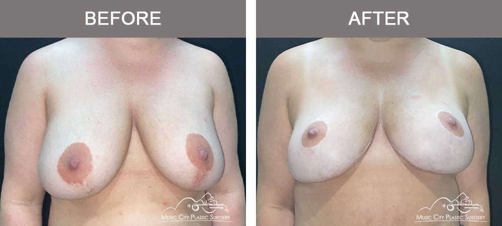 Mastopexy with Capsulectomy Before & After Gallery - Patient 395138 - Image 1