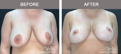 Mastopexy with Capsulectomy Before & After Gallery - Patient 395138 - Image 1