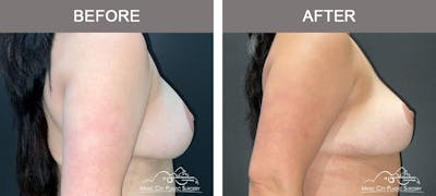 Mastopexy with Capsulectomy Before & After Gallery - Patient 395138 - Image 2