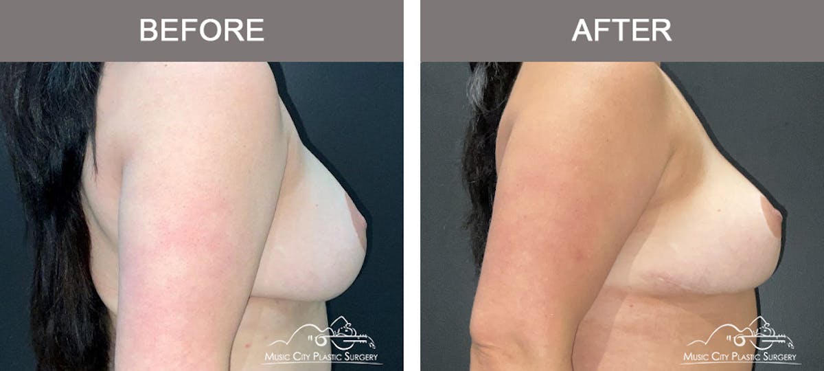 Mastopexy with Capsulectomy Before & After Gallery - Patient 395138 - Image 2