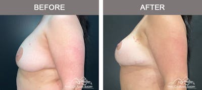 Mastopexy with Capsulectomy Before & After Gallery - Patient 395138 - Image 3