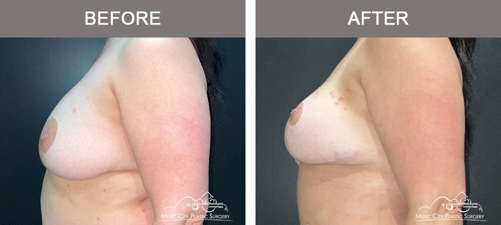 Mastopexy with Capsulectomy Before & After Gallery - Patient 395138 - Image 3