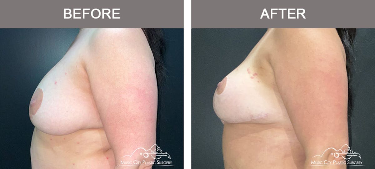 Mastopexy with Capsulectomy Before & After Gallery - Patient 395138 - Image 3
