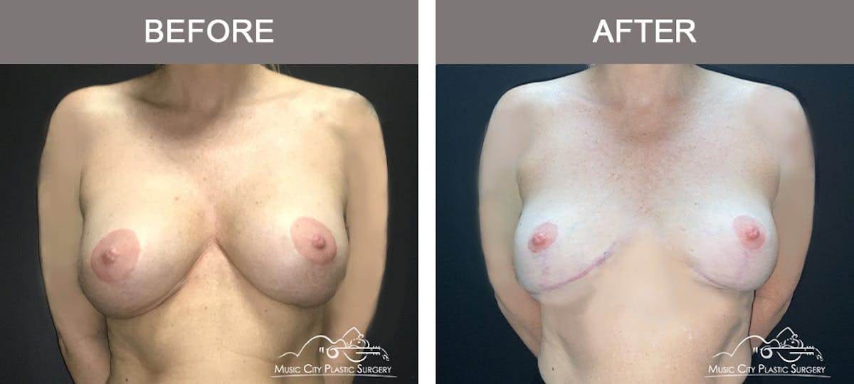 Mastopexy with Capsulectomy Before & After Gallery - Patient 244284 - Image 1