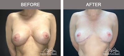 Mastopexy with Capsulectomy Before & After Gallery - Patient 244284 - Image 1