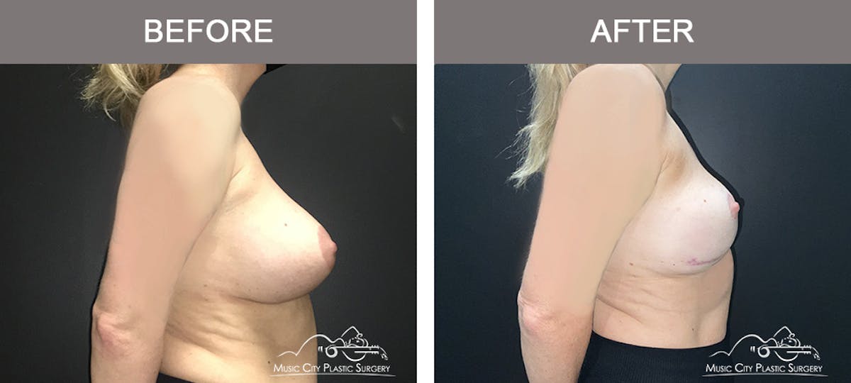 Mastopexy with Capsulectomy Before & After Gallery - Patient 244284 - Image 2