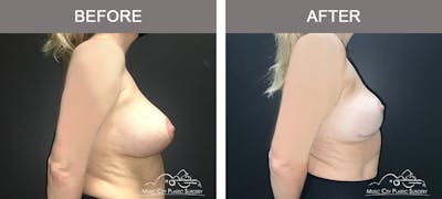 Mastopexy with Capsulectomy Before & After Gallery - Patient 244284 - Image 2