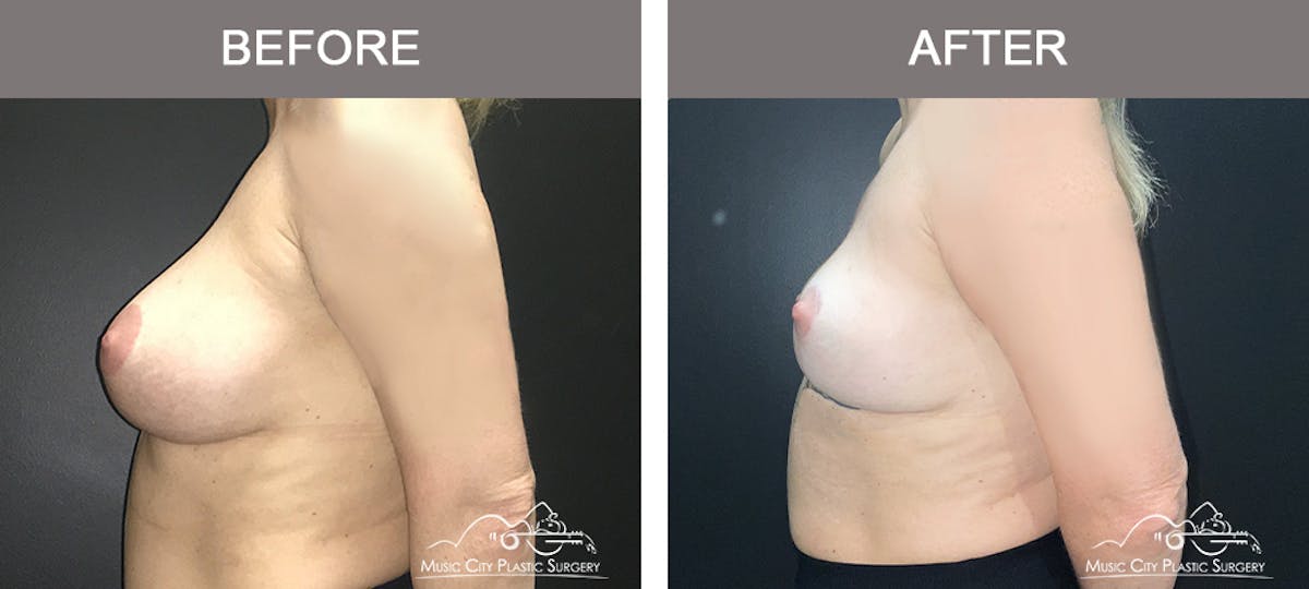 Mastopexy with Capsulectomy Before & After Gallery - Patient 244284 - Image 3