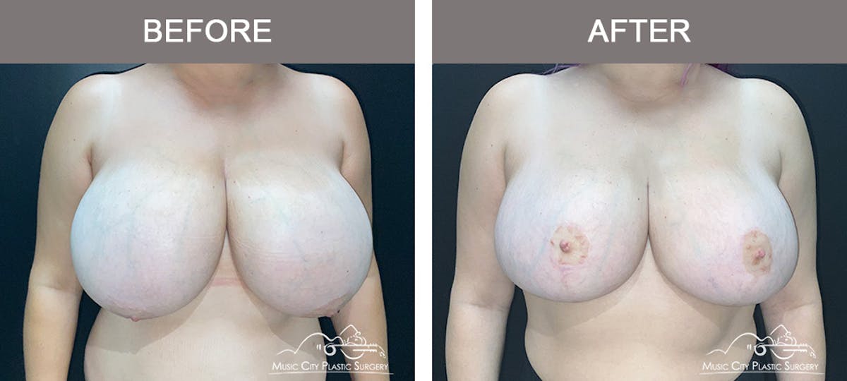 Breast Reduction Before & After Gallery - Patient 350721 - Image 1