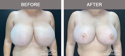 Breast Reduction Before & After Gallery - Patient 350721 - Image 1