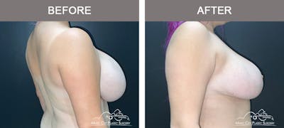 Breast Reduction Before & After Gallery - Patient 350721 - Image 2