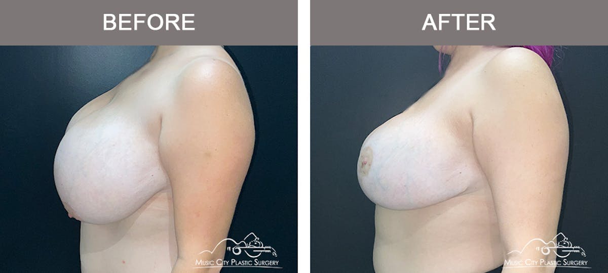 Breast Reduction Before & After Gallery - Patient 350721 - Image 3