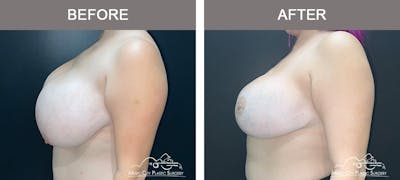 Breast Reduction Before & After Gallery - Patient 350721 - Image 3